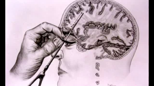 POV: You get a lobotomy but the last thing you watched was Vidlii